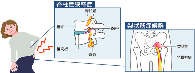 脊柱管狭窄症・梨状筋症候群のイメージ
