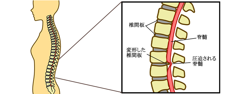 脊椎の圧迫イメージ